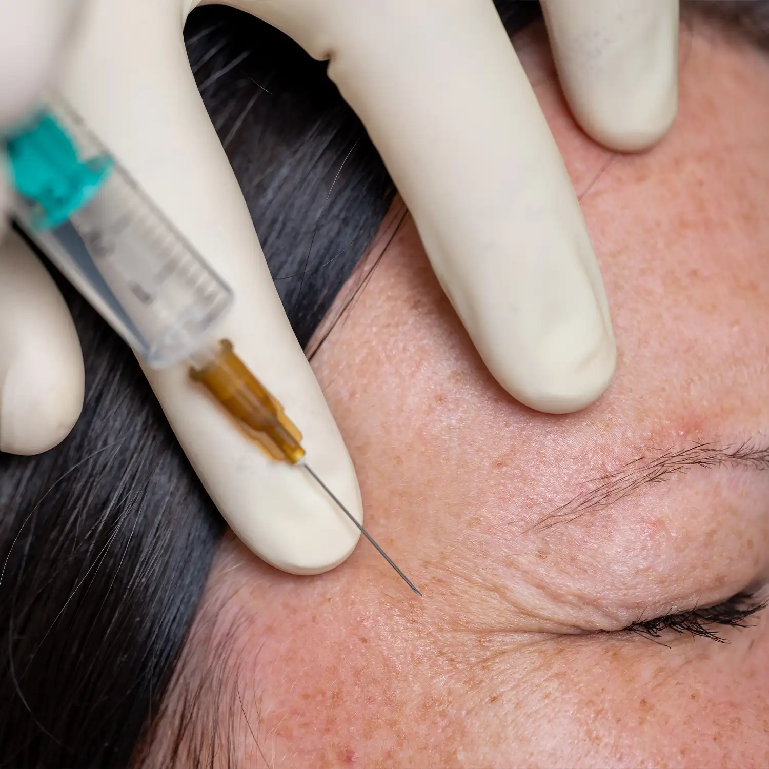 Eine Frau wird seitlich neben den Augen mit Botox behandelt.